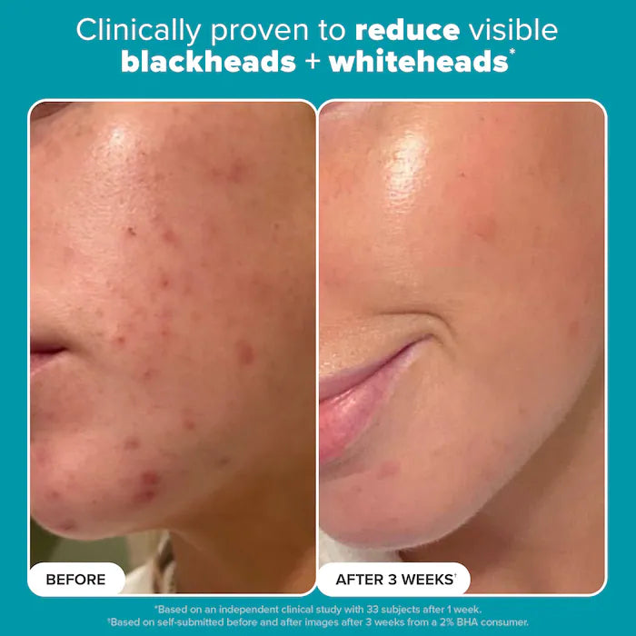 Paula's Choice 
Mini Skin Perfecting 2% BHA Liquid Exfoliant for Clear Skin